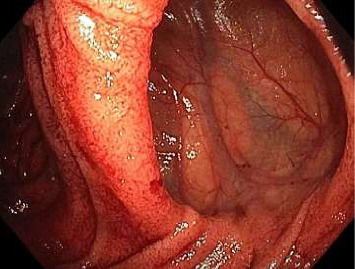 Jejunal Diverticular Bleeding on Long-Term Aspirin and Short-Term Corticosteroid Therapy.