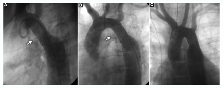 [Percutaneous treatment of aortic coartation and ductus arteriosus in a patient with Ebstein's anomaly].