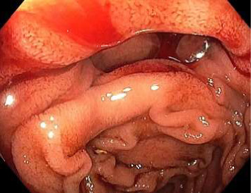 Jejunal Diverticular Bleeding on Long-Term Aspirin and Short-Term Corticosteroid Therapy.
