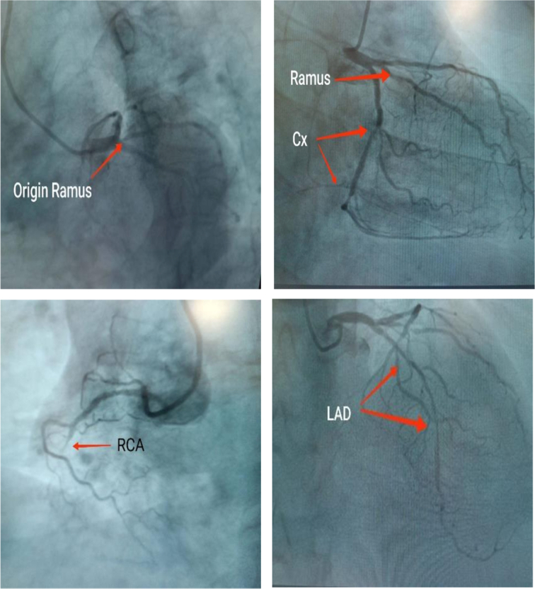 Combined coronary artery bypass grafting and orthopedic fixation in a patient with multiple comorbidities: a case report.