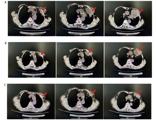 [A Case Report of EGFR-TKIs Resistant Secondary MET Gene Amplified  Lung Squamous Cell Carcinoma and Literature Review].