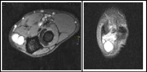 Ulnar Compression Neuropathy Secondary to Ganglion Cyst at the Elbow Joint: A Case Report.