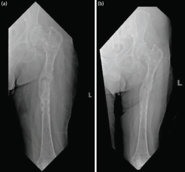 Functional Bracing in a Femur Non-union Following Fracture Related Infection: A Case Report.