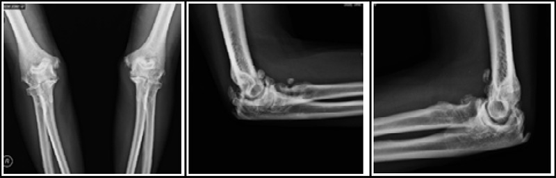 Ulnar Compression Neuropathy Secondary to Ganglion Cyst at the Elbow Joint: A Case Report.