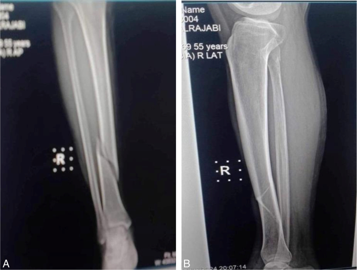 Combined coronary artery bypass grafting and orthopedic fixation in a patient with multiple comorbidities: a case report.