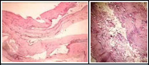 Ulnar Compression Neuropathy Secondary to Ganglion Cyst at the Elbow Joint: A Case Report.