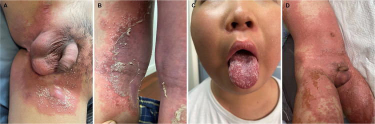 Zinc Supplementation for Acrodermatitis Enteropathica Overlapped with Psoriasiform Lesions.