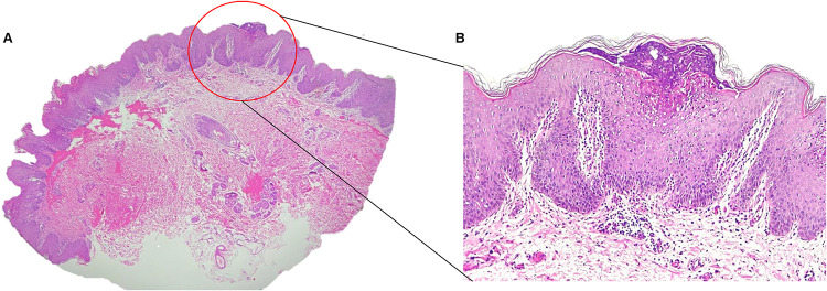 Zinc Supplementation for Acrodermatitis Enteropathica Overlapped with Psoriasiform Lesions.