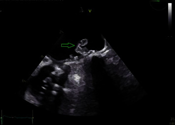 Cardioembolic Stroke Due to Prosthetic Valve Endocarditis Caused by <i>Candida parapsilosis</i>: A Case Report.