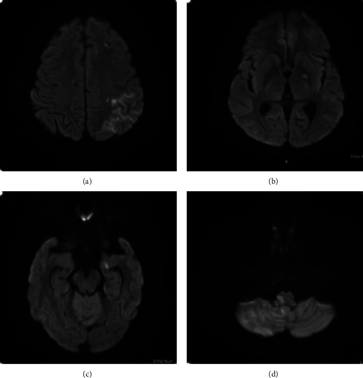Cardioembolic Stroke Due to Prosthetic Valve Endocarditis Caused by <i>Candida parapsilosis</i>: A Case Report.
