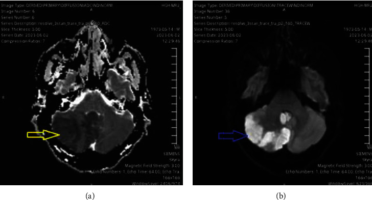 Cardioembolic Stroke Due to Prosthetic Valve Endocarditis Caused by <i>Candida parapsilosis</i>: A Case Report.