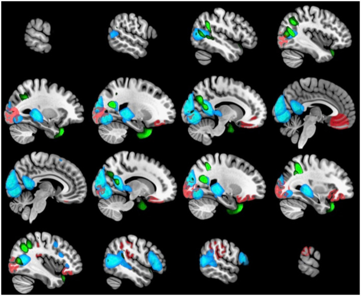 Adolescent brain maturation associated with environmental factors: a multivariate analysis.