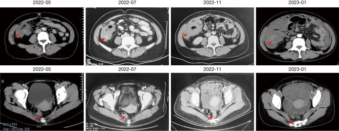 Differential response to immunotherapy in different lesions of MSI-H double primary colorectal cancer: a case report and literature review.