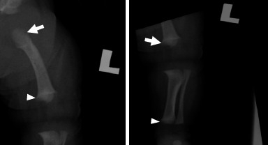 Prenatal diagnosis of achondroplasia in primary care settings - Recognising the soft markers: A case report.