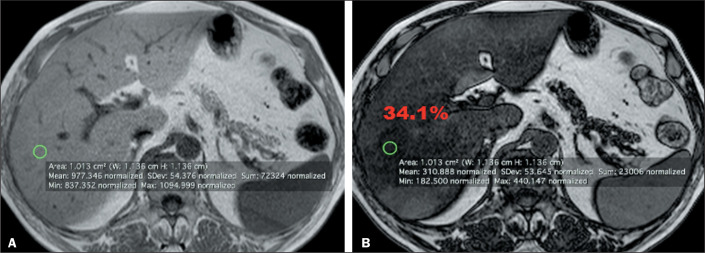 Quantification of hepatic fat: evaluation of different magnetic resonance imaging measurement strategies in cases of homogeneous and heterogeneous distribution.