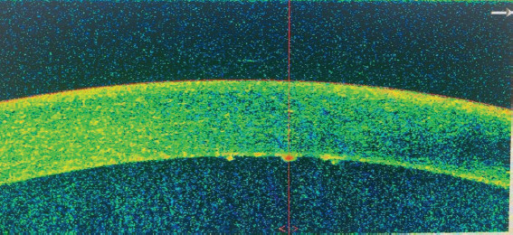 Advanced UltraTech approach for distinguishing granulomatous from non-granulomatous corneal endothelial exudates in autoimmune rheumatic anterior uveitis.
