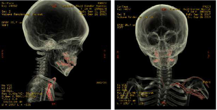 Incidental Radiological Finding of an Intravenous Needle in a Pediatric Cervical Spine.