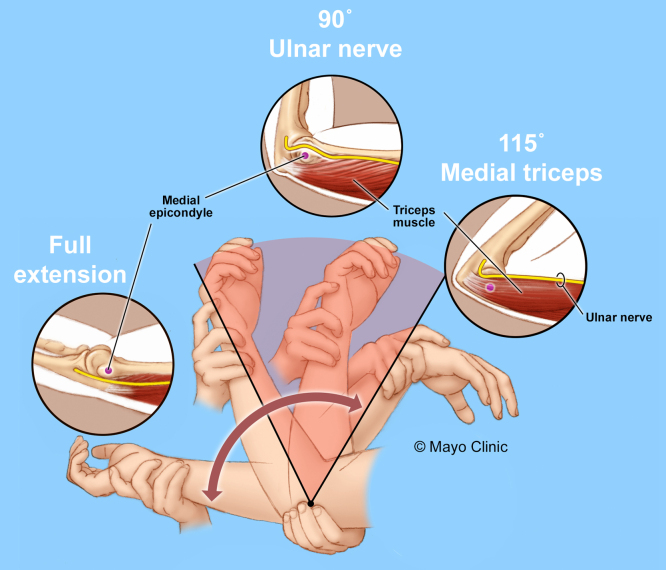 Failed ulnar nerve surgery due to persistent unrecognized snapping triceps from cubitus varus due to a distal humeral malunion in an adult: illustrative case.