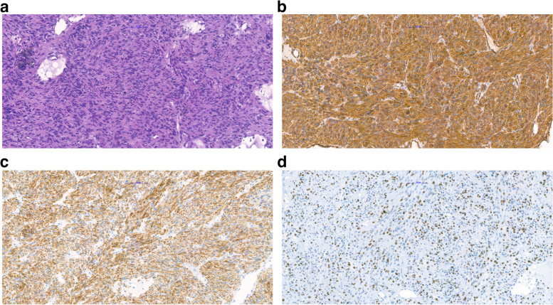 Sternotomy and extracorporal circulation for fulminant Budd-Chiari syndrome due to leiomyosarcoma of the inferior vena cava.