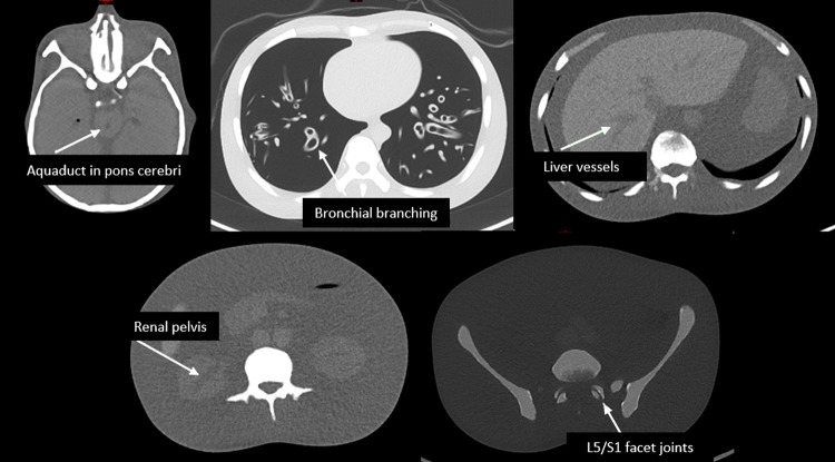 CT radiation dose reduction with tin filter for localisation/characterisation level image quality in PET-CT: a phantom study.