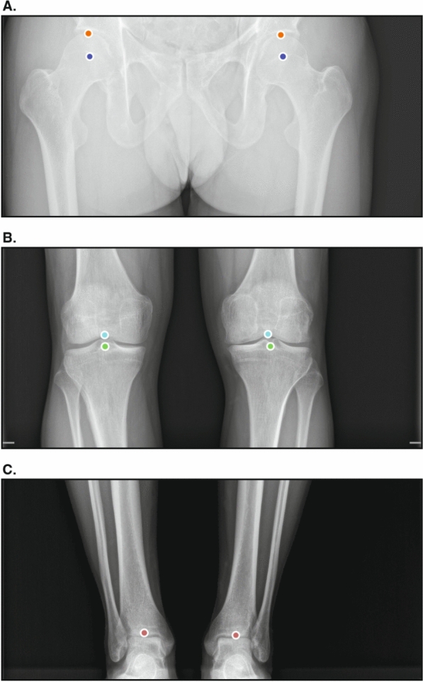 Evaluation of a deep learning software for automated measurements on full-leg standing radiographs.
