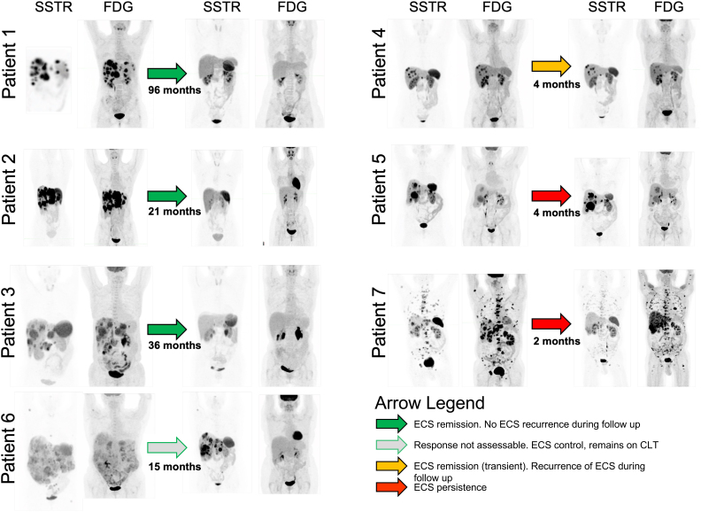 Peptide receptor radionuclide therapy for ectopic Cushing's syndrome caused by metastatic neuroendocrine neoplasms.