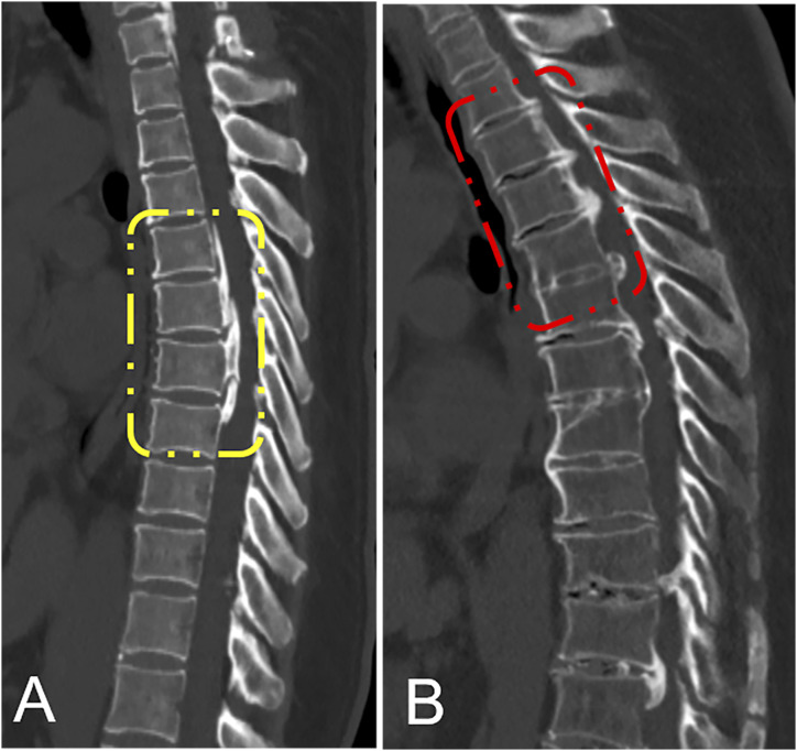 Factors Affecting the Surgical Outcomes of Patients Treated With "de-tension" Surgical Strategy for Multilevel Ossification of the Posterior Longitudinal Ligament in the Thoracic Spine: A Minimum 2-year Follow-Up Study of 83 Patients in a Single Center.