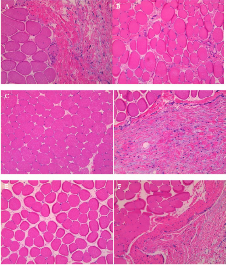 Nanoparticle ultrasonication: a promising approach for reducing bacterial biofilm in total joint infection-an in vivo rat model investigation.