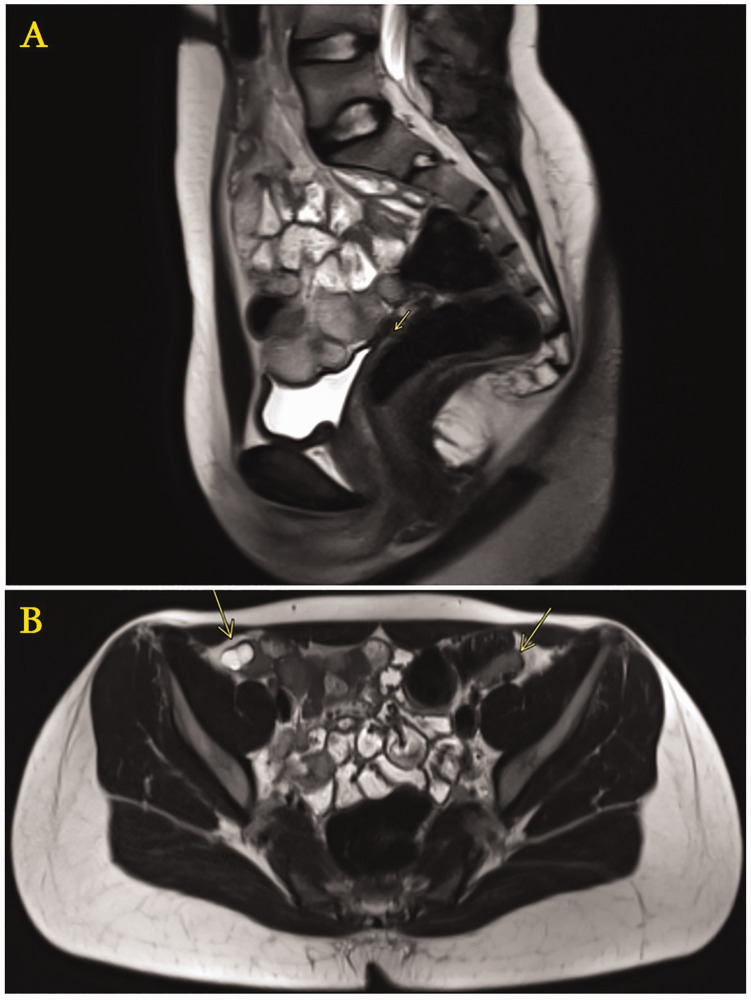 Complexities of complete androgen insensitivity syndrome: insights from a case report and literature review.