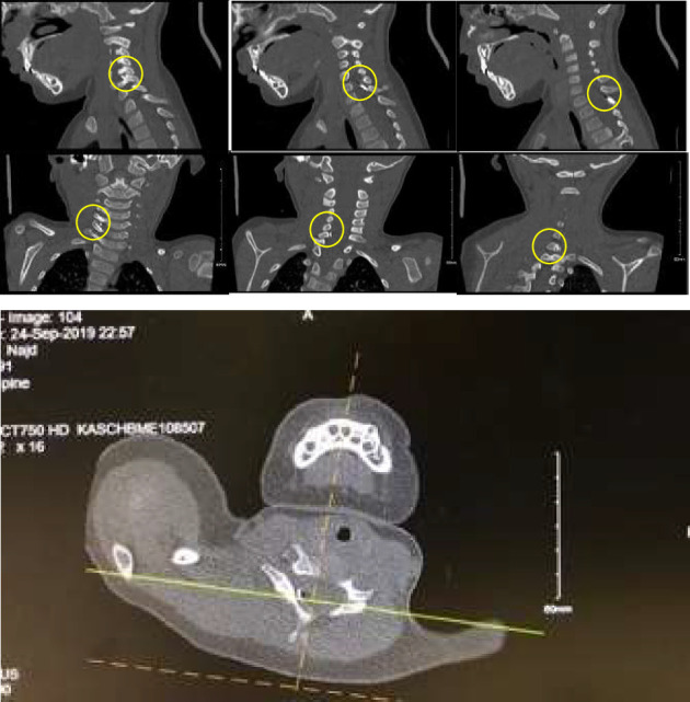 Incidental Radiological Finding of an Intravenous Needle in a Pediatric Cervical Spine.