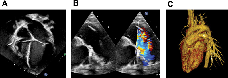 Management of Patent Ductus Arteriosus Endarteritis in Children.