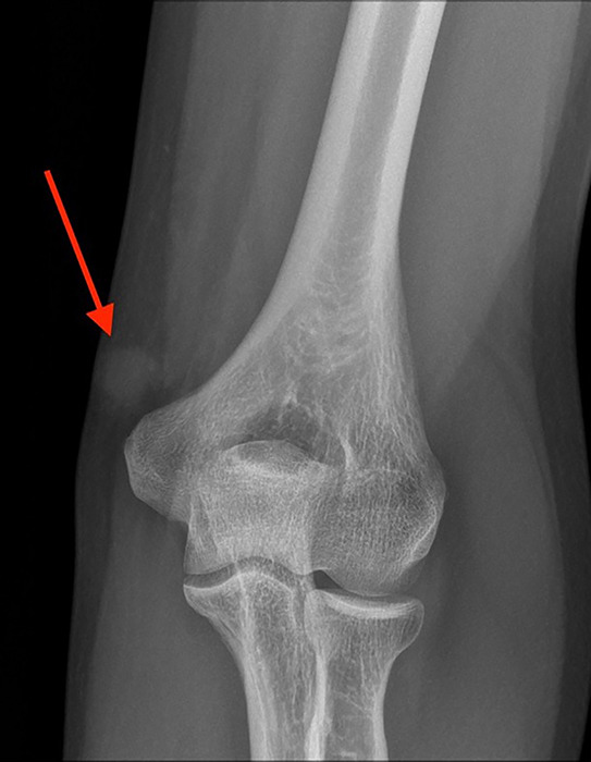 Extradigital Glomus Tumor at the Elbow.