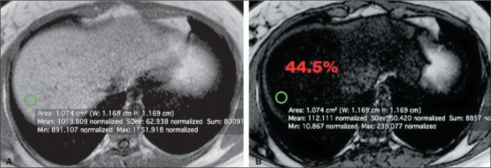 Quantification of hepatic fat: evaluation of different magnetic resonance imaging measurement strategies in cases of homogeneous and heterogeneous distribution.