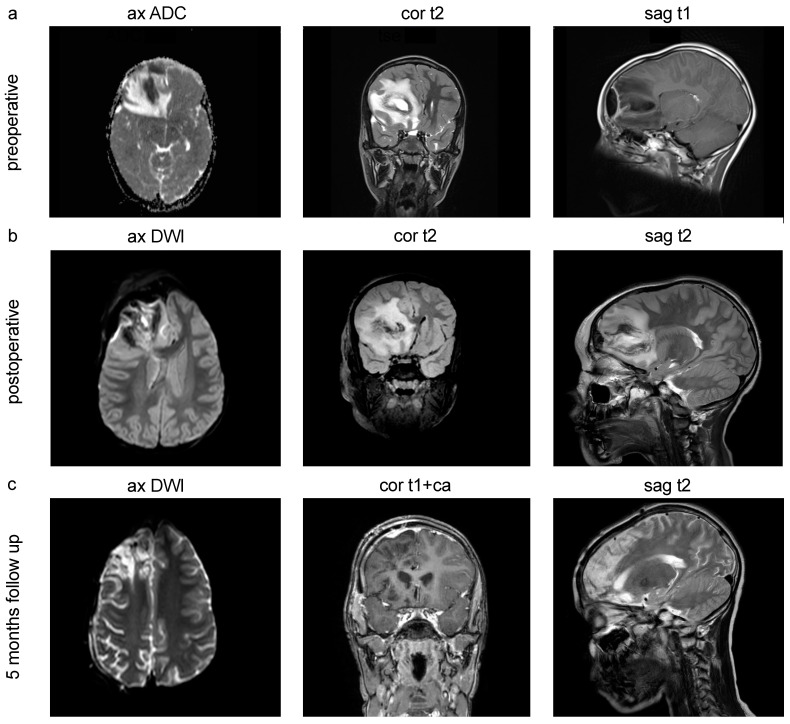 Characterization of Disease Patterns in Children with Intracranial Abscesses for Enhanced Clinical Decision-Making.