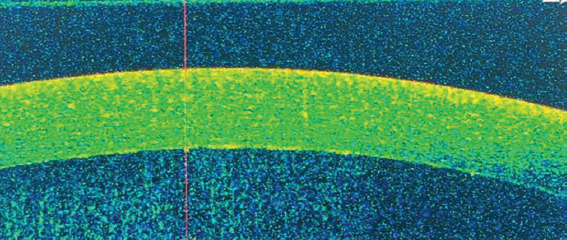 Advanced UltraTech approach for distinguishing granulomatous from non-granulomatous corneal endothelial exudates in autoimmune rheumatic anterior uveitis.