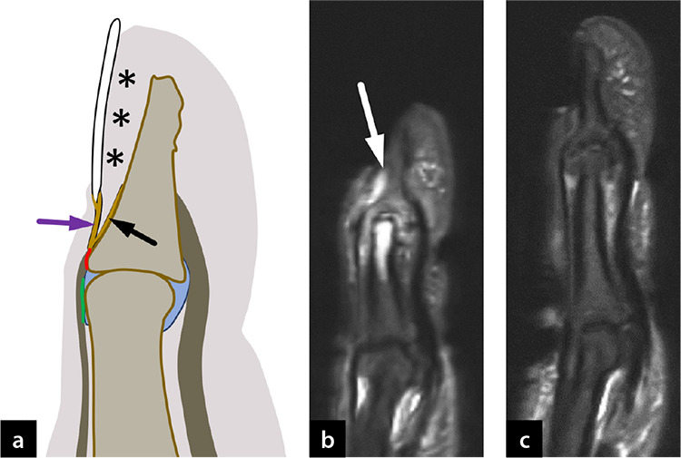 Pivotal role of the synovioentheseal complex in the imaging of arthritis and rheumatic diseases