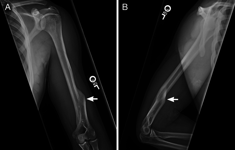 Failed ulnar nerve surgery due to persistent unrecognized snapping triceps from cubitus varus due to a distal humeral malunion in an adult: illustrative case.