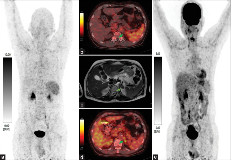 An Unusual Case of Primary Aldosteronism with Negative <sup>68</sup>Ga-Pentixafor PET/CT and Positive FDG-PET/CT in a Left Adrenal Adenoma.