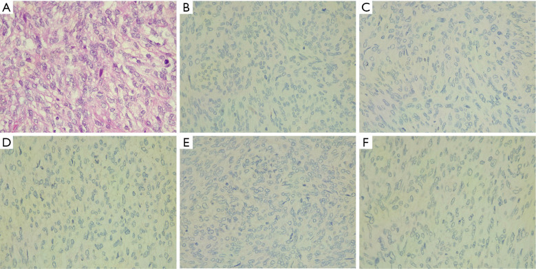 Radical tumor resection of a relapsed high-grade endometrial stromal sarcoma with an extremely rare mutation: a case report.