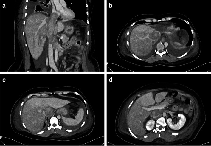 Sternotomy and extracorporal circulation for fulminant Budd-Chiari syndrome due to leiomyosarcoma of the inferior vena cava.