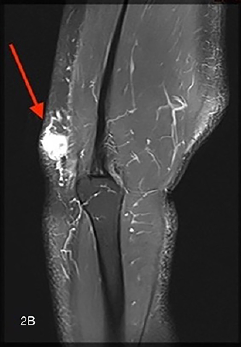 Extradigital Glomus Tumor at the Elbow.
