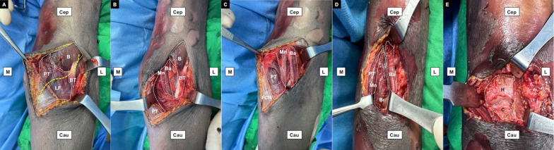 Outcomes of coronoid-first repair through an anterior approach in patients with terrible triad injury of the elbow: a prospective study with a minimum 2-year follow-up.