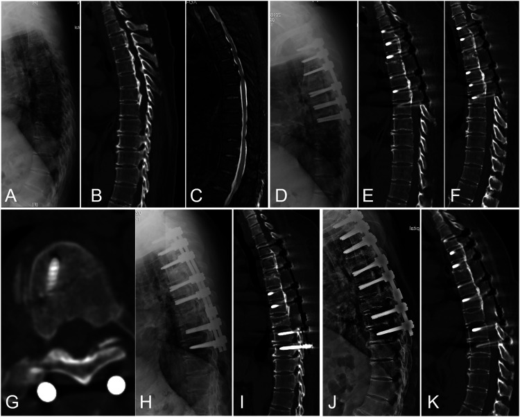 Factors Affecting the Surgical Outcomes of Patients Treated With "de-tension" Surgical Strategy for Multilevel Ossification of the Posterior Longitudinal Ligament in the Thoracic Spine: A Minimum 2-year Follow-Up Study of 83 Patients in a Single Center.