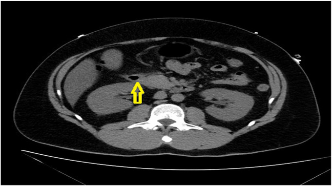 Diabetic Ketoacidosis Without Diabetes Mellitus in Acute Pancreatitis