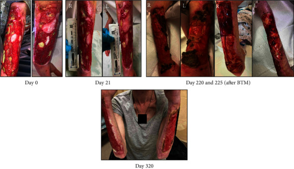 Treatment of Xylazine-Associated Injection Skin Injuries.