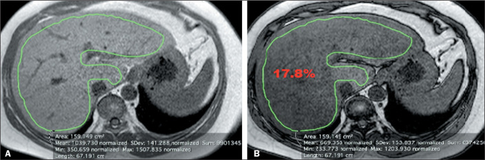 Quantification of hepatic fat: evaluation of different magnetic resonance imaging measurement strategies in cases of homogeneous and heterogeneous distribution.