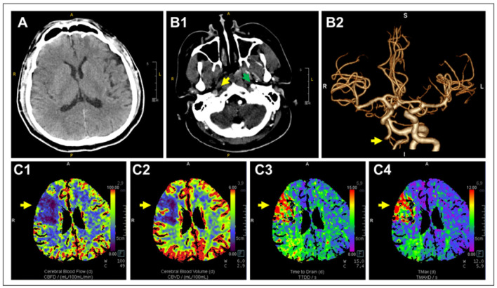 Stanford Type A Aortic Dissection Masquerading as Acute Ischemic Stroke: A Case Report.