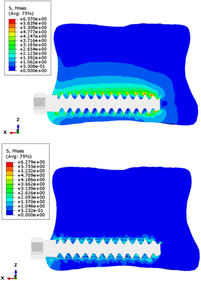 A novel personalized homogenous finite element model to predict the pull-out strength of cancellous bone screws.