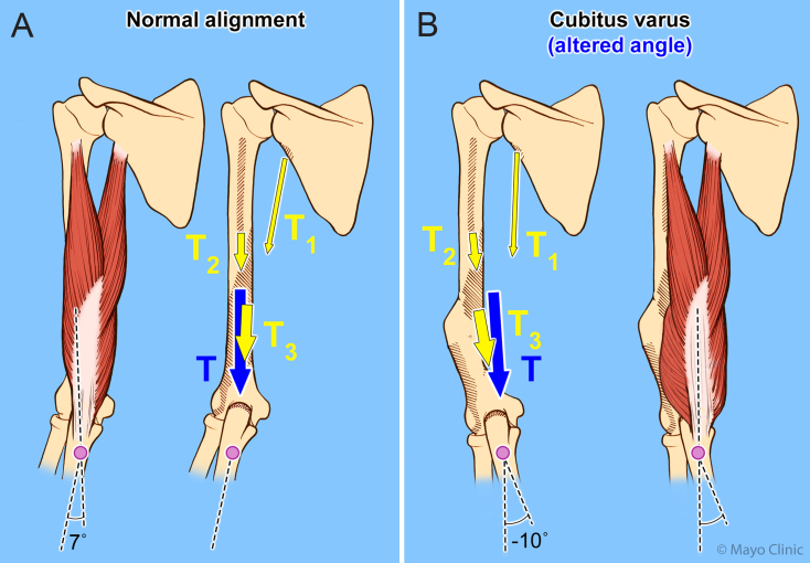 Failed ulnar nerve surgery due to persistent unrecognized snapping triceps from cubitus varus due to a distal humeral malunion in an adult: illustrative case.