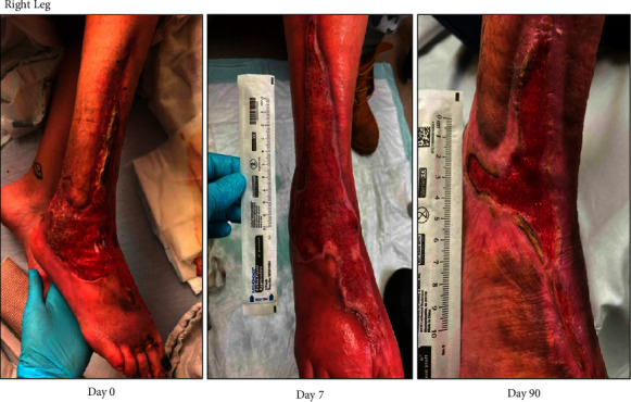 Treatment of Xylazine-Associated Injection Skin Injuries.